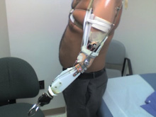 Prosthetic arm socket fitting and function testing. - Garrison's Prosthetic Services