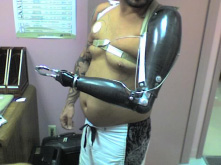 Prosthetic arm with graphite finish and proportional control chest expansion harness. - Garrison's Prosthetic Services