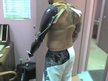 Prosthetic arm in full elbow extension. - Garrison's Prosthetic Services
